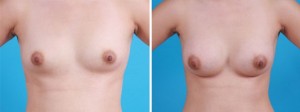 Breast Augmentation | Atlanta | Before and After Photos | Dr. Marcia Byrd
