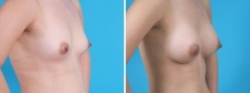 Breast Augmentation | Atlanta | Before and After Photos | Dr. Marcia Byrd