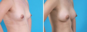 | Atlanta | Before and After Photos | Dr. Marcia Byrd