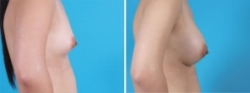 Breast Augmentation | Atlanta | Before and After Photos | Dr. Marcia Byrd