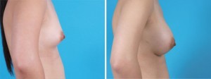 Breast Augmentation | Atlanta | Before and After Photos | Dr. Marcia Byrd
