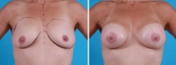 Breast Augmentation | Atlanta | Before and After Photos | Dr. Marcia Byrd