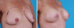 Breast Augmentation | Atlanta | Before and After Photos | Dr. Marcia Byrd