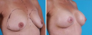 Breast Augmentation | Atlanta | Before and After Photos | Dr. Marcia Byrd