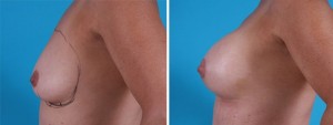 | Atlanta | Before and After Photos | Dr. Marcia Byrd