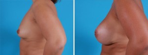 Breast Augmentation | Atlanta | Before and After Photos | Dr. Marcia Byrd
