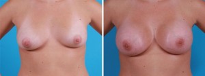 | Atlanta | Before and After Photos | Dr. Marcia Byrd