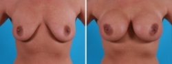 Breast Augmentation | Atlanta | Before and After Photos | Dr. Marcia Byrd