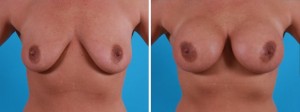 | Atlanta | Before and After Photos | Dr. Marcia Byrd