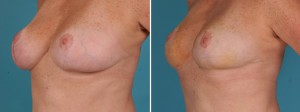 Breast Reduction | Atlanta | Before and After Photos | Dr. Marcia Byrd
