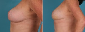 Breast Reduction | Atlanta | Before and After Photos | Dr. Marcia Byrd