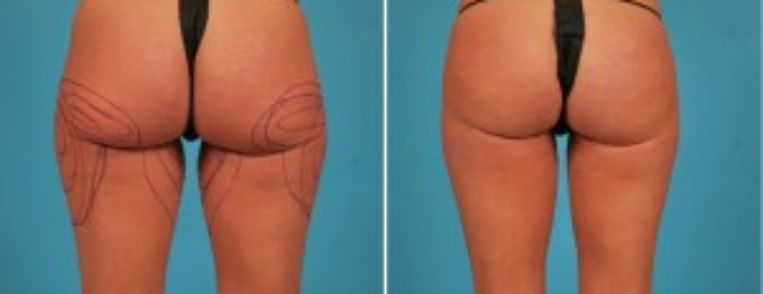 Brazilian Butt Lift | Atlanta | Before and After Photos | Dr. Marcia Byrd
