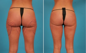 Brazilian Butt Lift | Atlanta | Before and After Photos | Dr. Marcia Byrd