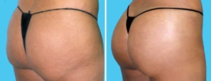 Brazilian Butt Lift | Atlanta | Before and After Photos | Dr. Marcia Byrd