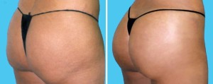 Brazilian Butt Lift | Atlanta | Before and After Photos | Dr. Marcia Byrd