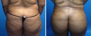 Brazilian Butt Lift | Atlanta | Before and After Photos | Dr. Marcia Byrd