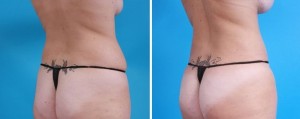 Brazilian Butt Lift | Atlanta | Before and After Photos | Dr. Marcia Byrd