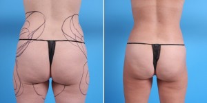 Brazilian Butt Lift | Atlanta | Before and After Photos | Dr. Marcia Byrd