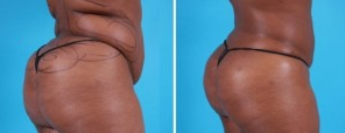 Brazilian Butt Lift | Atlanta | Before and After Photos | Dr. Marcia Byrd
