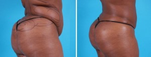 Brazilian Butt Lift | Atlanta | Before and After Photos | Dr. Marcia Byrd
