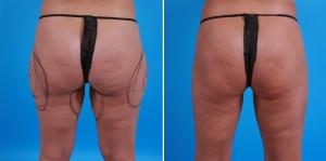 Brazilian Butt Lift | Atlanta | Before and After Photos | Dr. Marcia Byrd
