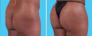 Brazilian Butt Lift | Atlanta | Before and After Photos | Dr. Marcia Byrd