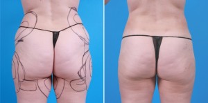 Brazilian Butt Lift | Atlanta | Before and After Photos | Dr. Marcia Byrd