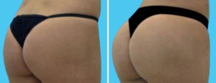 Brazilian Butt Lift | Atlanta | Before and After Photos | Dr. Marcia Byrd