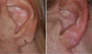 Earlobe Repair | Atlanta | Before and After Photos | Dr. Marcia Byrd