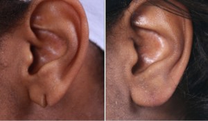 Earlobe Repair | Atlanta | Before and After Photos | Dr. Marcia Byrd