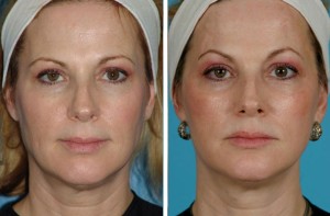 | Atlanta | Before and After Photos | Dr. Marcia Byrd