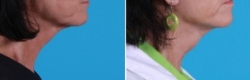 Facial Laser Lift | Atlanta | Patient 2 | Before and After Photos | Side View | Dr. Marcia Byrd