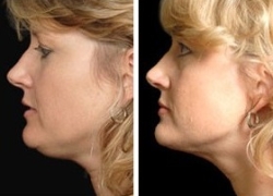 Facial Laser Lift | Atlanta | Before and After Photos | Dr. Marcia Byrd