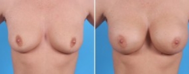 | Atlanta | Before and After Photos | Dr. Marcia Byrd