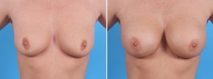 Fat Transfer Breasts | Atlanta | Before and After Photos | Dr. Marcia Byrd