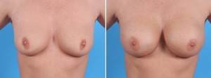 Fat Transfer Breasts | Atlanta | Before and After Photos | Dr. Marcia Byrd