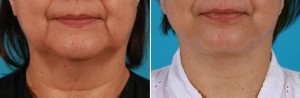 | Atlanta | Before and After Photos | Dr. Marcia Byrd
