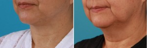| Atlanta | Before and After Photos | Dr. Marcia Byrd