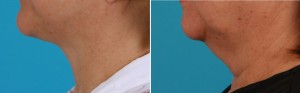 | Atlanta | Before and After Photos | Dr. Marcia Byrd