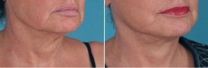 | Atlanta | Before and After Photos | Dr. Marcia Byrd