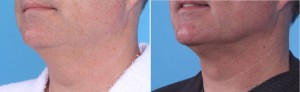 | Atlanta | Before and After Photos | Dr. Marcia Byrd