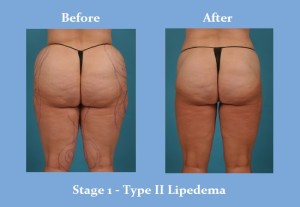 | Atlanta | Before and After Photos | Dr. Marcia Byrd