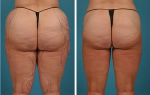 | Atlanta | Before and After Photos | Dr. Marcia Byrd
