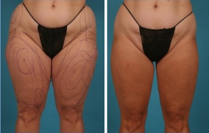| Atlanta | Before and After Photos | Dr. Marcia Byrd