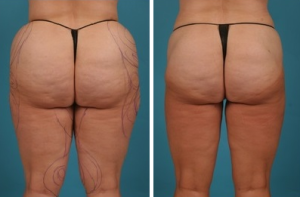 | Atlanta | Before and After Photos | Dr. Marcia Byrd