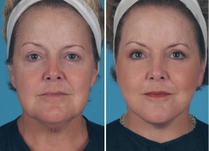 | Atlanta | Before and After Photos | Dr. Marcia Byrd
