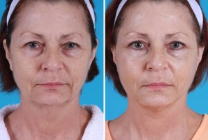 | Atlanta | Before and After Photos | Dr. Marcia Byrd