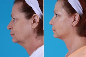 | Atlanta | Before and After Photos | Dr. Marcia Byrd