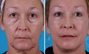 | Atlanta | Before and After Photos | Dr. Marcia Byrd