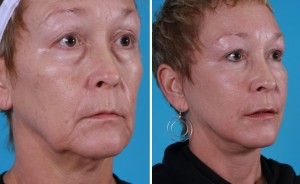 | Atlanta | Before and After Photos | Dr. Marcia Byrd